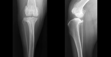 Patellar Luxation